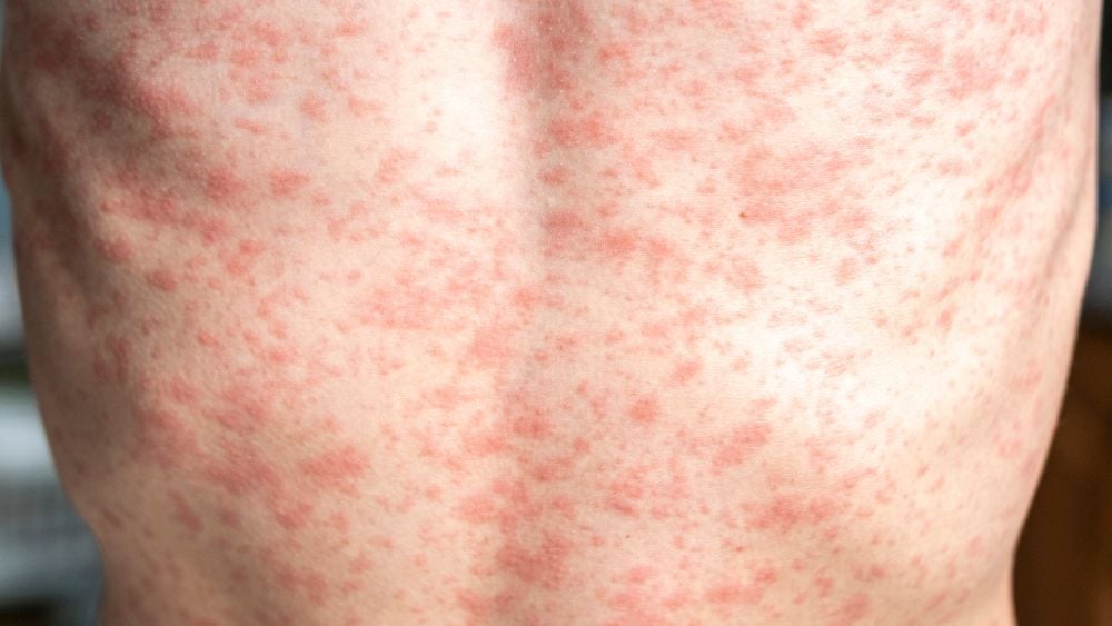 Measles rash on chest of young teenage boy