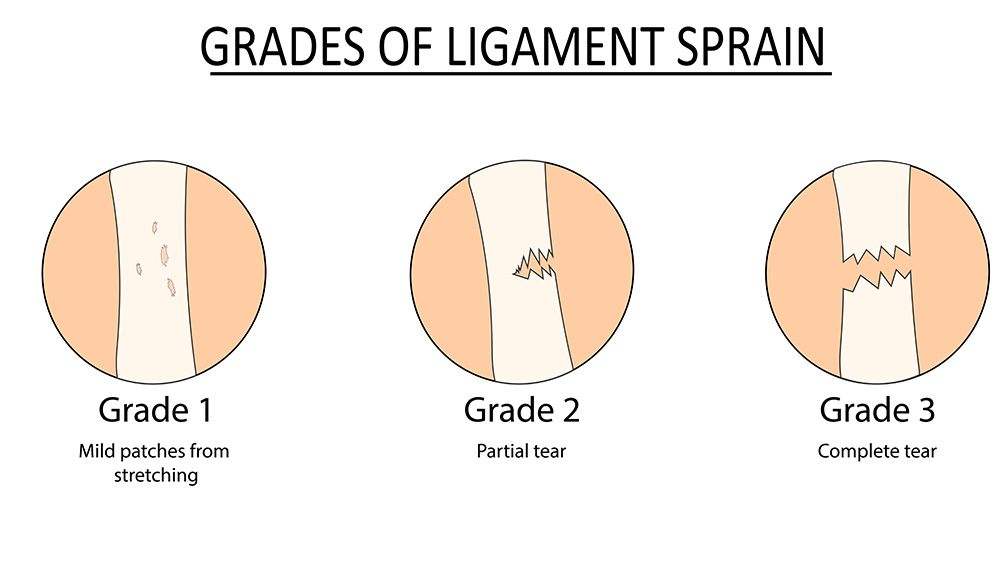 Grades of ligament sprain. Grade 1 has mild patches from stretching. Grade 2 partial tear. Grade 3 complete tear