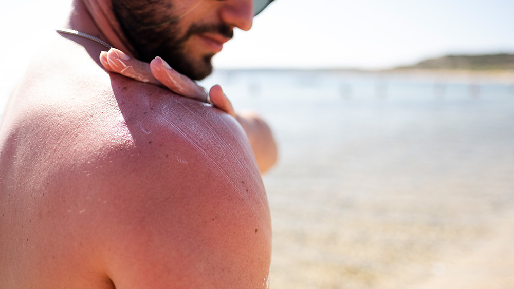 Man with sunburn