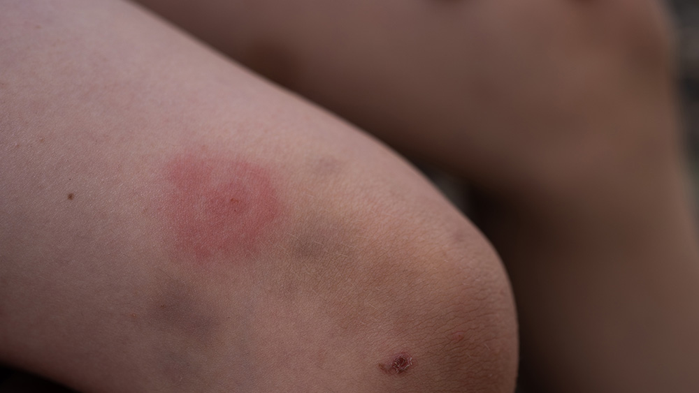 Tick bite