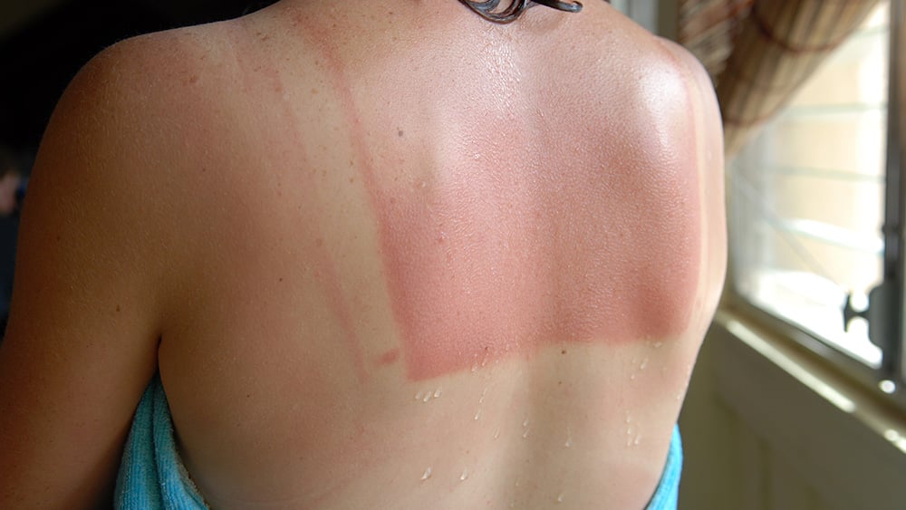 A woman with a sunburned back stands with a towel wrapped around her after a shower.