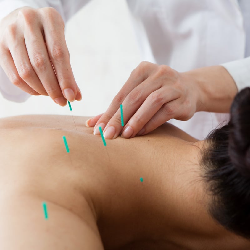 Man receiving acupuncture.