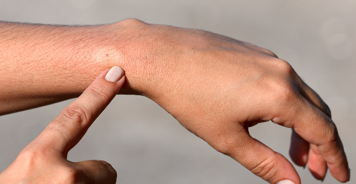 Hand pointing to a persons wrist where they have a bee sting