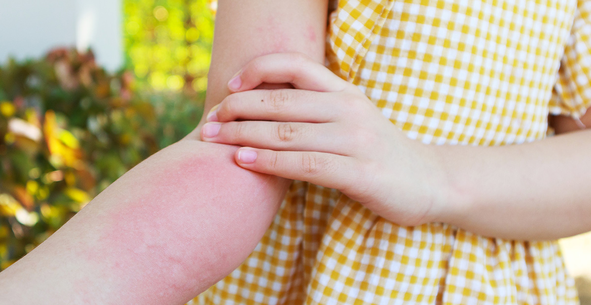 Little girl has skin rash allergy and itchy on her arm