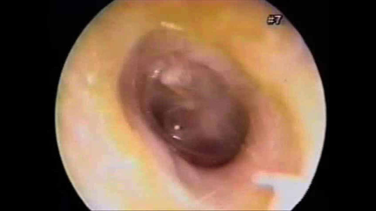 Otitis Media with Effusion