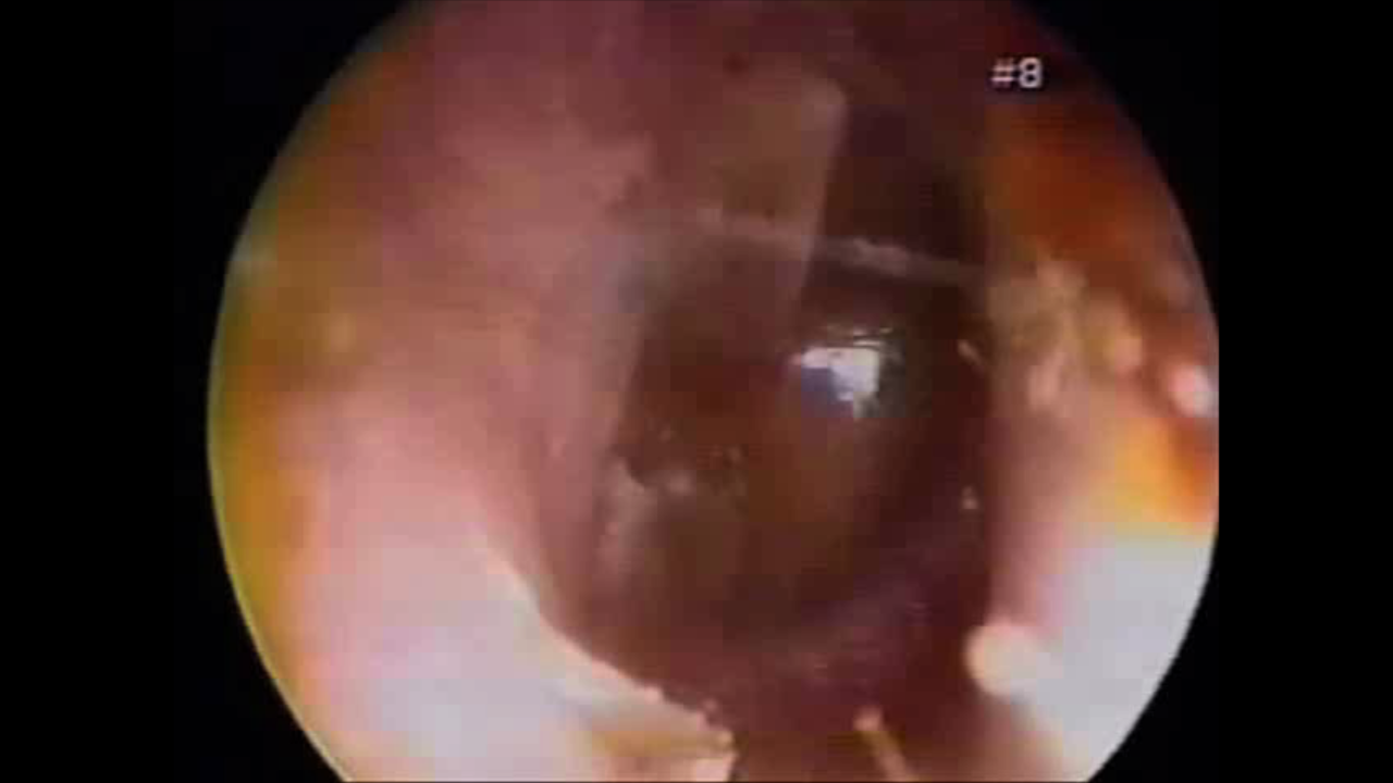 Otitis Media with Effusion