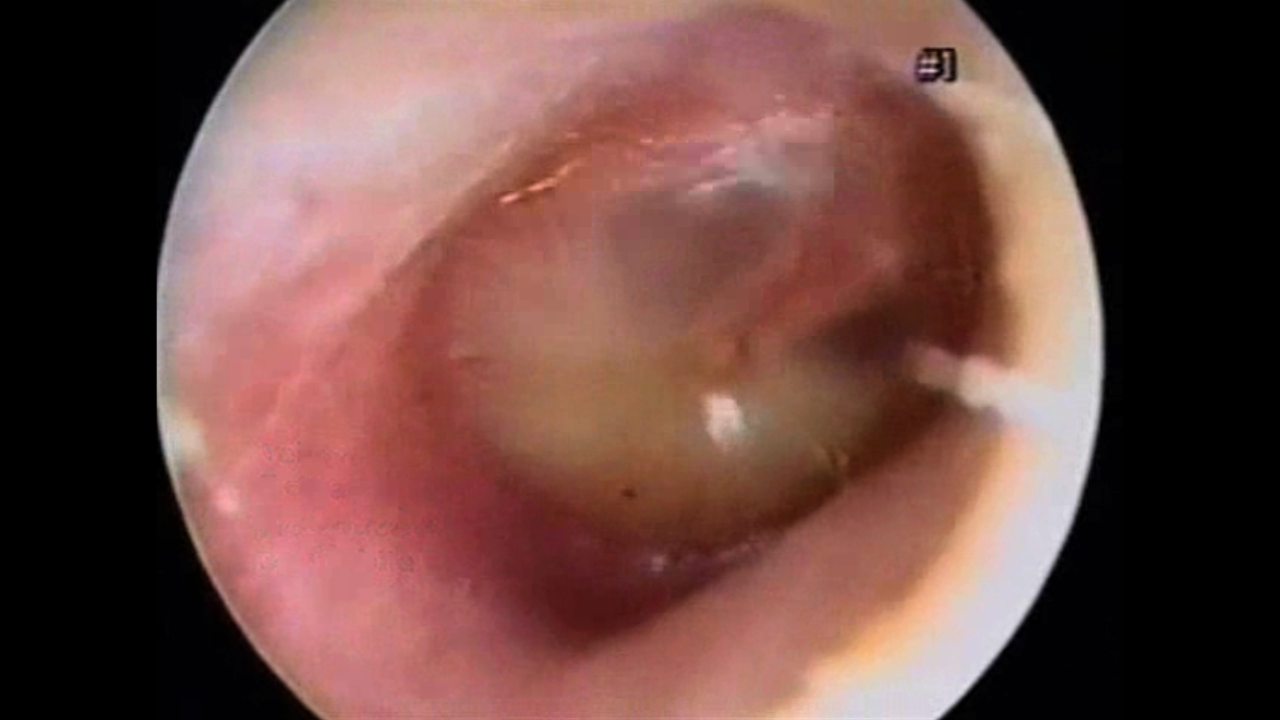 Acute Otitis Media (Bacteria)