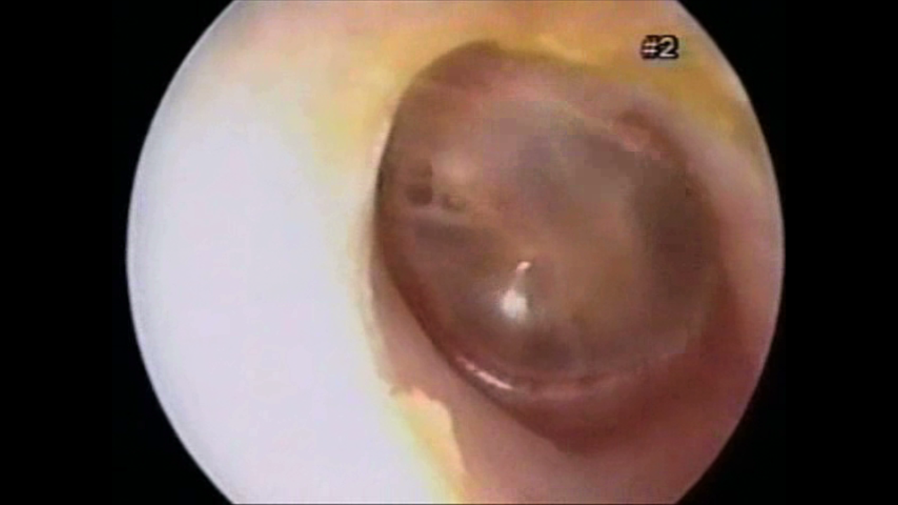Otitis Media with Effusion (Virus)