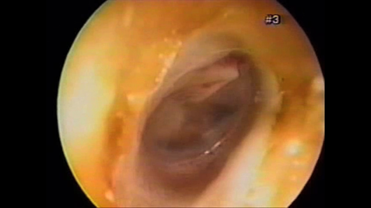 Otitis Media with Effusion