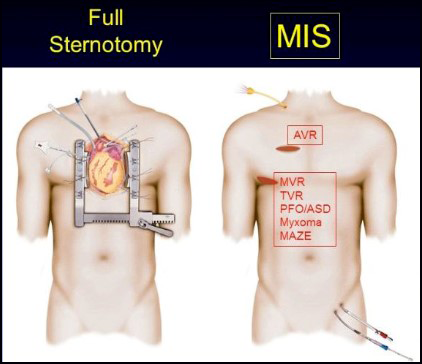 Minimally Invasive Heart Surgery