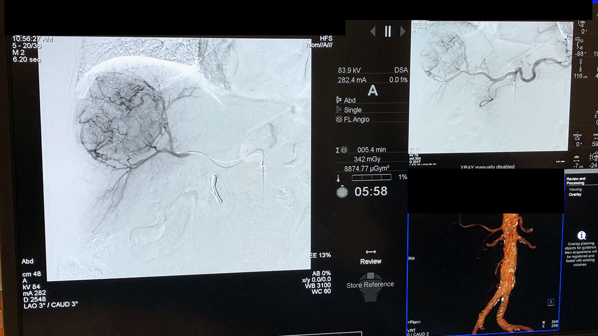 IR Cancer Treatment 