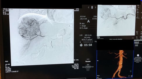 IR Cancer Treatment 