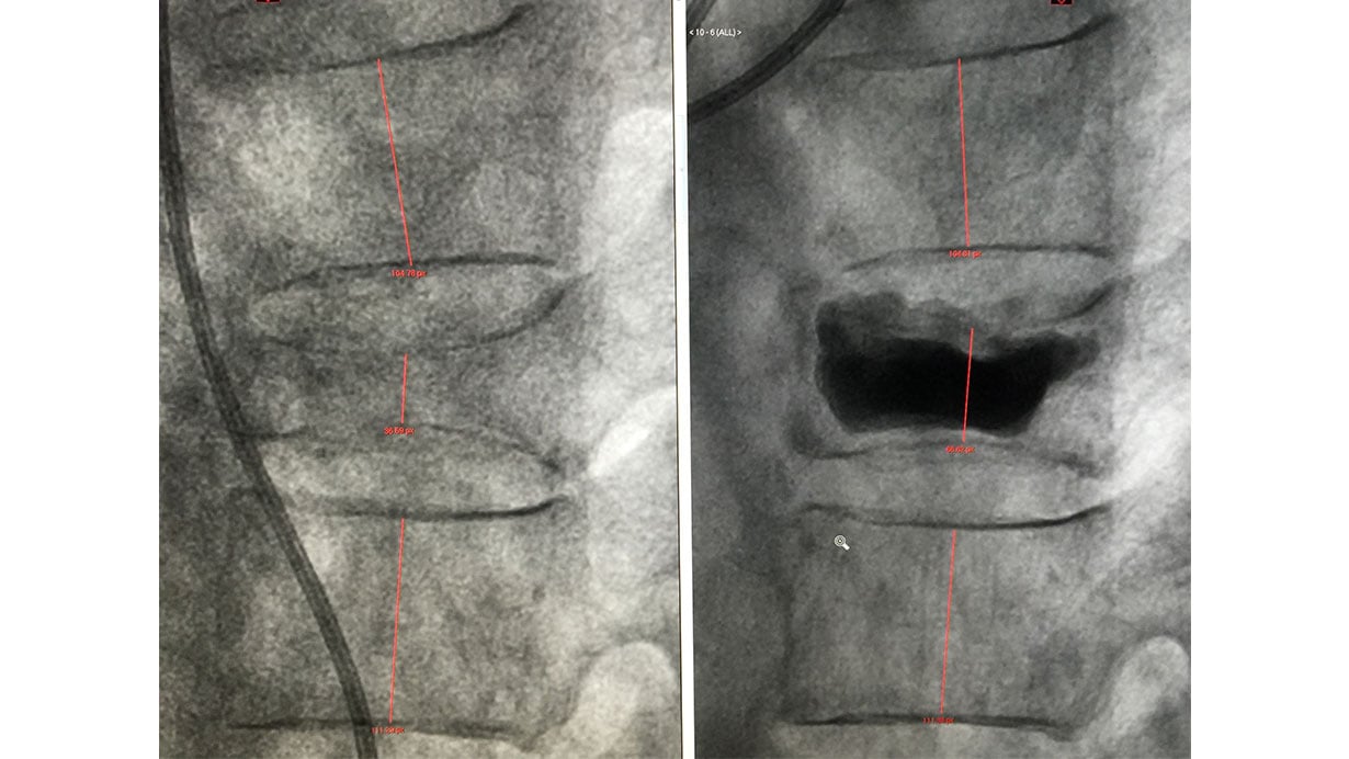 Kyphoplasty