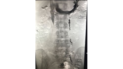 Pelvic Venous Disease