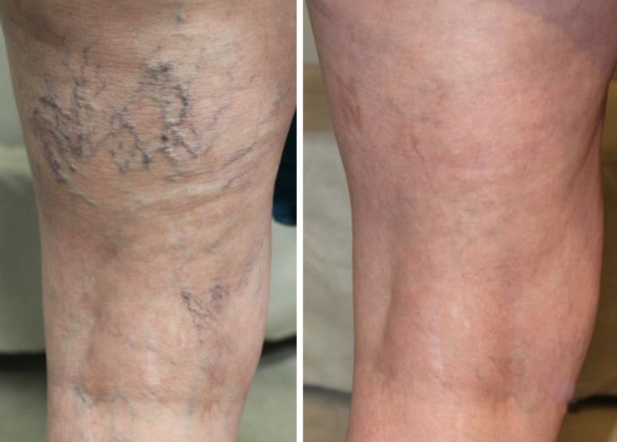 spider veins before and after image