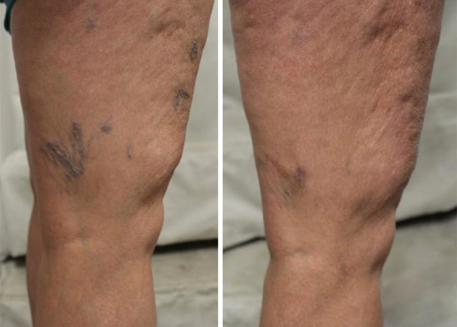 spider veins before and after image