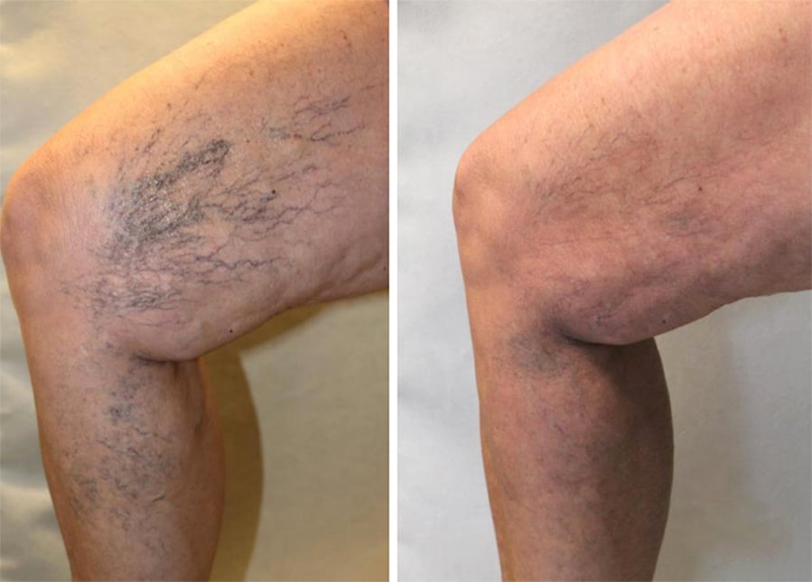 spider veins before and after image