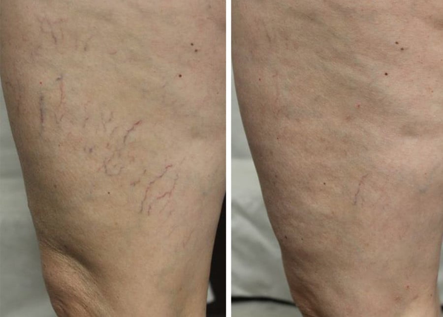 spider veins before and after image