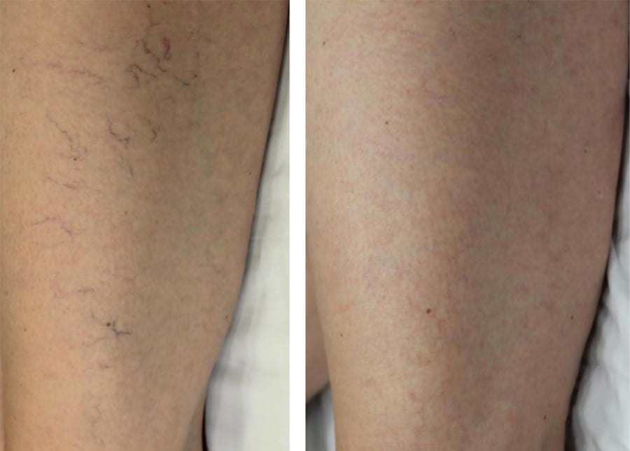 spider veins before and after image