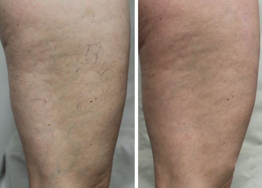 spider veins before and after image