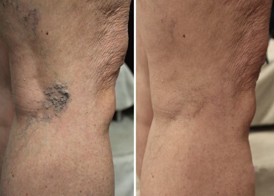 spider veins before and after image