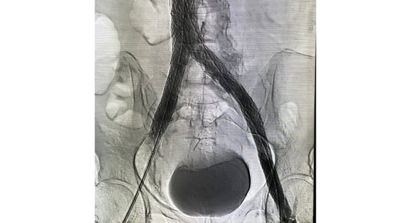 DVT stent