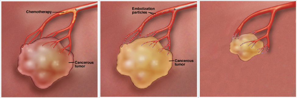 illustration of a tumor