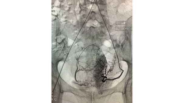 UFE Angiography