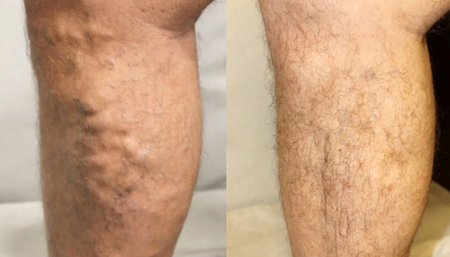 varicose veins before and after image