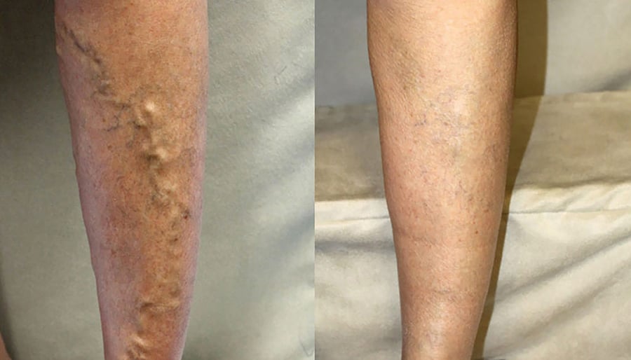 varicose veins before and after image