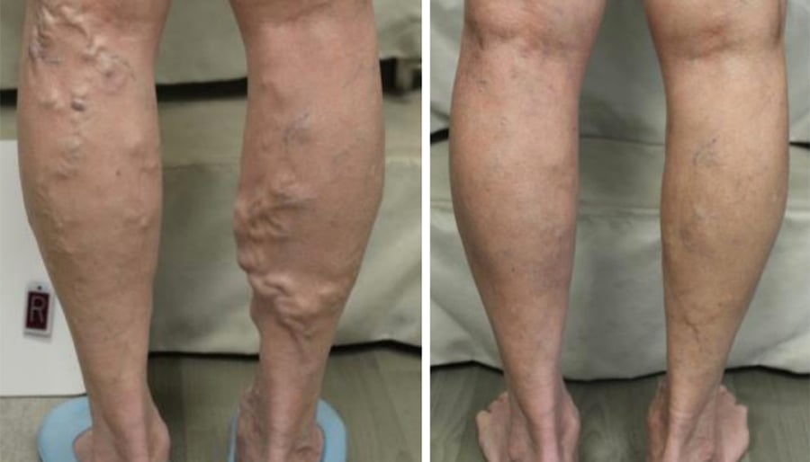 varicose veins before and after image