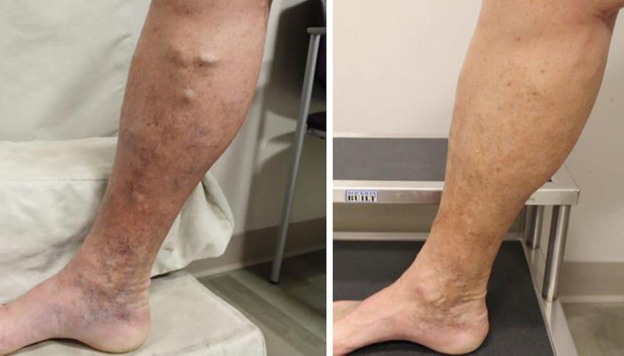 varicose veins before and after image