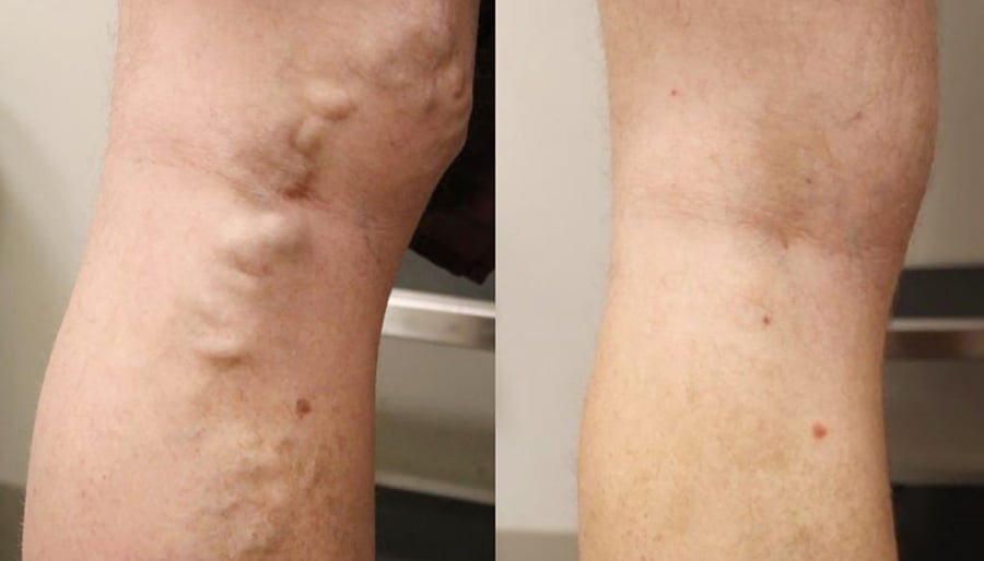 varicose veins before and after image