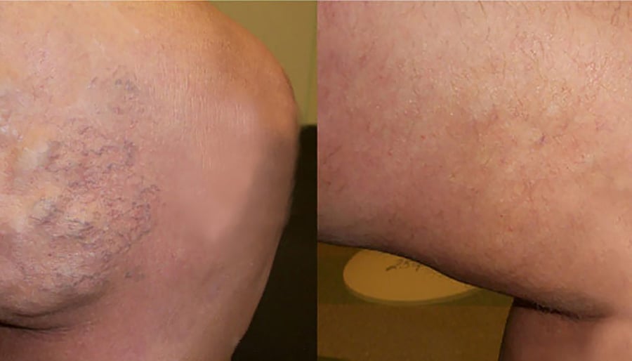 varicose veins before and after image