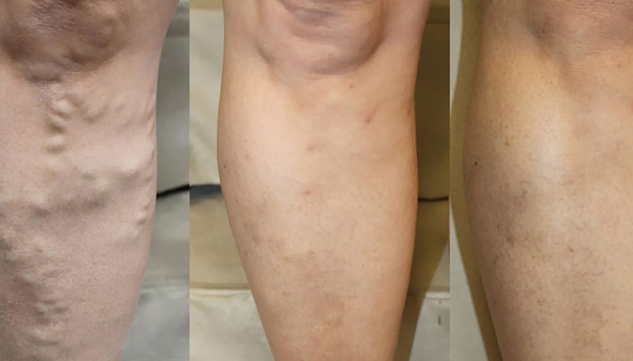varicose veins before and after image