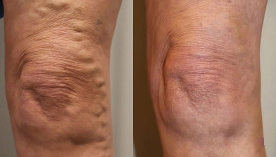 varicose veins before and after image