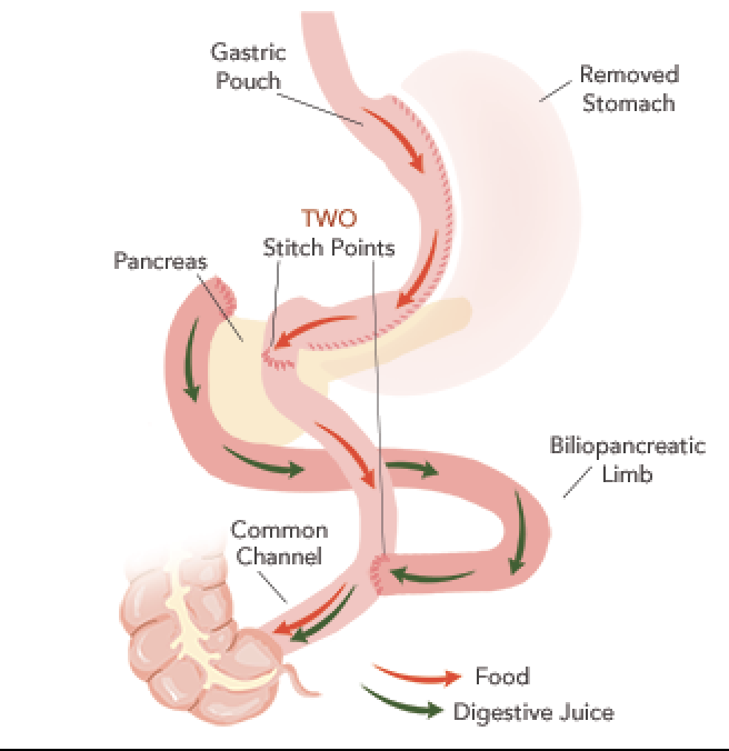 Duodenal