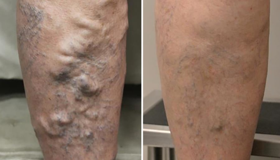 varicose veins on the leg before and after results
