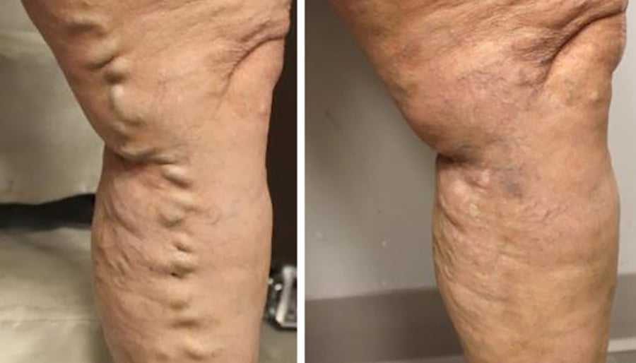 varicose veins on the leg before and after results