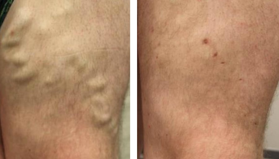 varicose veins on the leg before and after results