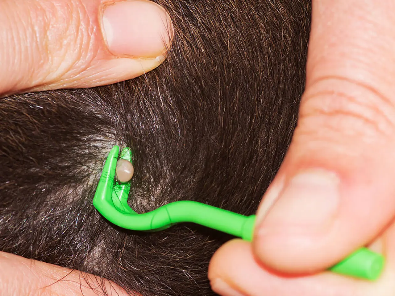 Una garrapata siendo removida del cuero cabelludo con una herramienta manual verde