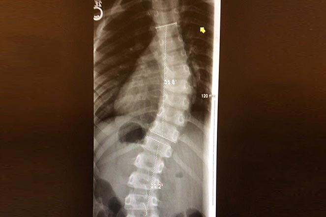 scoliosis patient spine X-ray