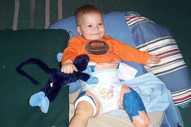 an infant with a leg cast