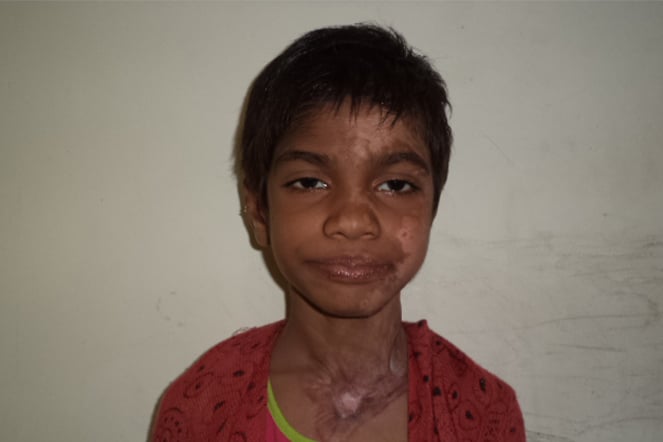a young child with burn scars