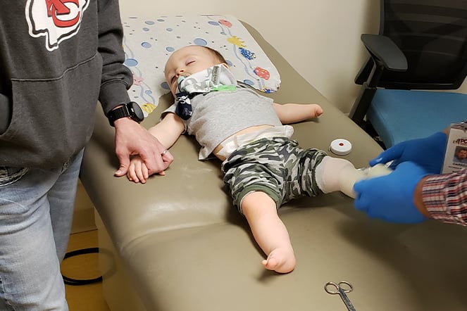 an infant lays down while being outfitted for a leg prosthetic