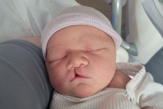 a sleeping infant with a cleft lip