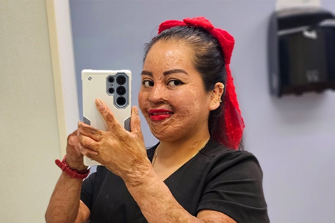a woman with burn scars taking a mirror selfie 