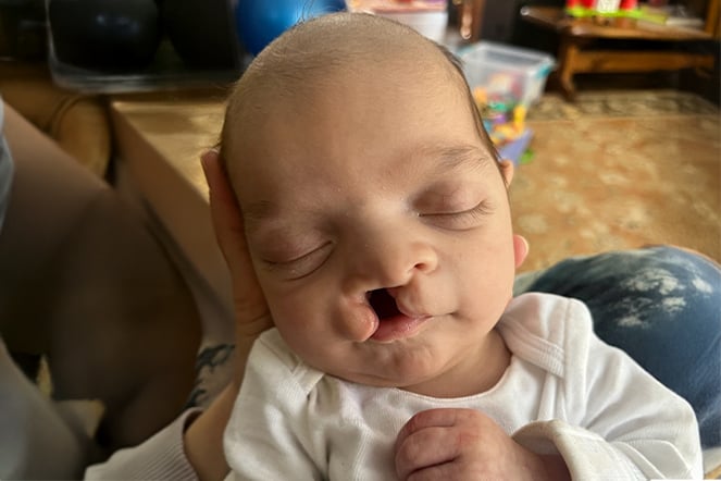 a sleeping baby with a cleft lip and palate