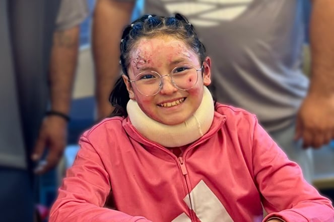 a smiling child with burn scars