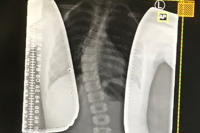 an x-ray of a spine with a curve